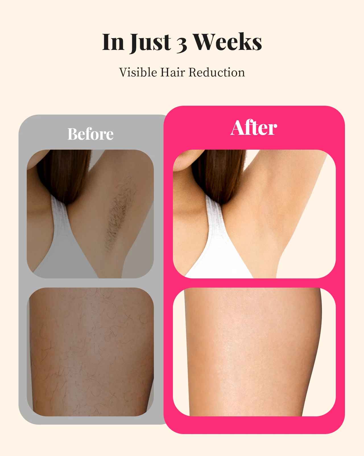 IPL Hair Removal Device 990000 Flashes – Permanent Painless Laser Hair Removal for Face, Body & Bikini-Hair Removal Laser Device-Blushia
